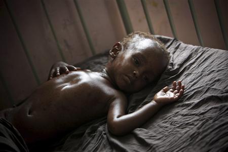 A malnourished and dehydrated child lies on a bed in Banadir hospital in Mogadishu A malnourished and dehydrated child lies on a bed in Banadir hospital in Mogadishu