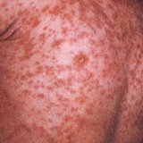 Measles