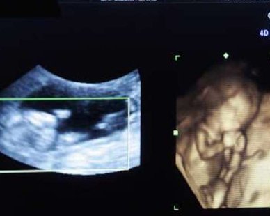 A four dimensional ultrasound is seen at a pregnancy clinic in Arlington, Texas. REUTERS/Jessica Rinaldi A four dimensional ultrasound is seen at a pregnancy clinic in Arlington, Texas. REUTERS/Jessica Rinaldi