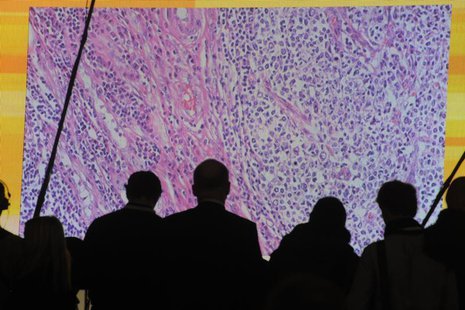 Cancer cells are seen on a large screen connected to a microscope at the CeBit computer fair in Hanover, March, 6, 2012. REUTERS/Fabian Bimm Cancer cells are seen on a large screen connected to a microscope at the CeBit computer fair in Hanover, March, 6, 2012. REUTERS/Fabian Bimm