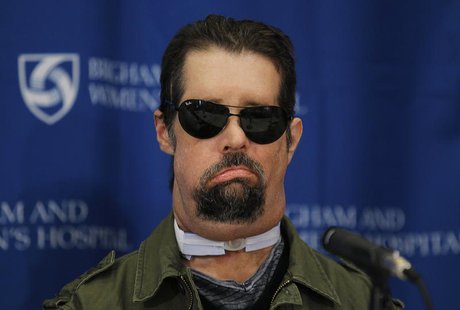 Dallas Wiens, the United States' first full face transplant patient, speaks to reporters at a news conference at Brigham and Women's Hospita Dallas Wiens, the United States' first full face transplant patient, speaks to reporters at a news conference at Brigham and Women's Hospita