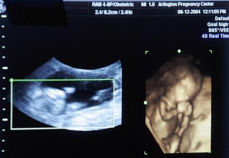 A four dimensional ultrasound is seen at a pregnancy clinic in Arlington, Texas November 26, 2007. REUTERS/Jessica Rinaldi A four dimensional ultrasound is seen at a pregnancy clinic in Arlington, Texas November 26, 2007. REUTERS/Jessica Rinaldi