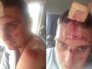 Joshua Peterson shows off cut on forehead he says he received from arresting Outagamie County Sheriff's deputies during an OWI stop. Joshua Peterson shows off cut on forehead he says he received from arresting Outagamie County Sheriff's deputies during an OWI stop.
