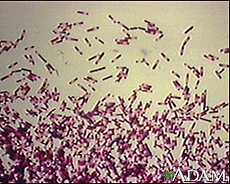 C-diff or Clostridium Difficile C-diff or Clostridium Difficile