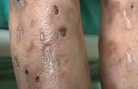 Effects of the drug Krokodil seen on legs of a user. (Photo from: YouTube). Effects of the drug Krokodil seen on legs of a user. (Photo from: YouTube).