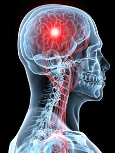 concussion concussion