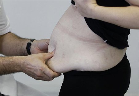 A surgeon examines an obese patient in his office as she prepares for surgery at a hospital, in Saint Jean d'Angley, southwestern France, Ja A surgeon examines an obese patient in his office as she prepares for surgery at a hospital, in Saint Jean d'Angley, southwestern France, Ja