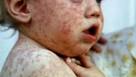 Measles Measles